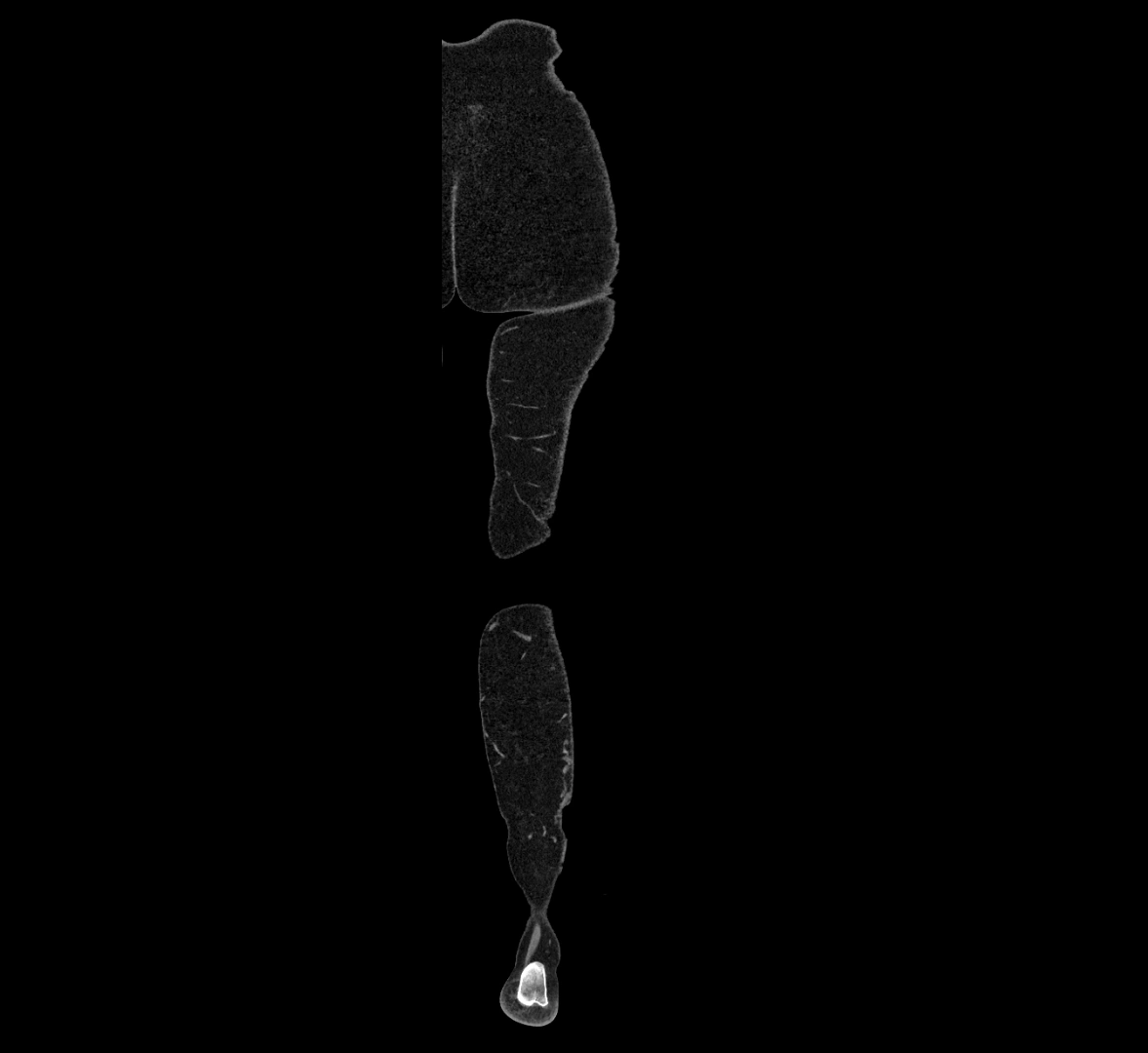 CTA lower limb coronal cross sectional anatomy labelled image _92 (2).webp